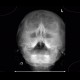 Acute sinusitis: X-ray - Plain radiograph